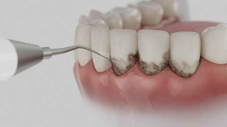 Trusted Wisdom Tooth Removal service in Jackson, WY - Dentist Open Now